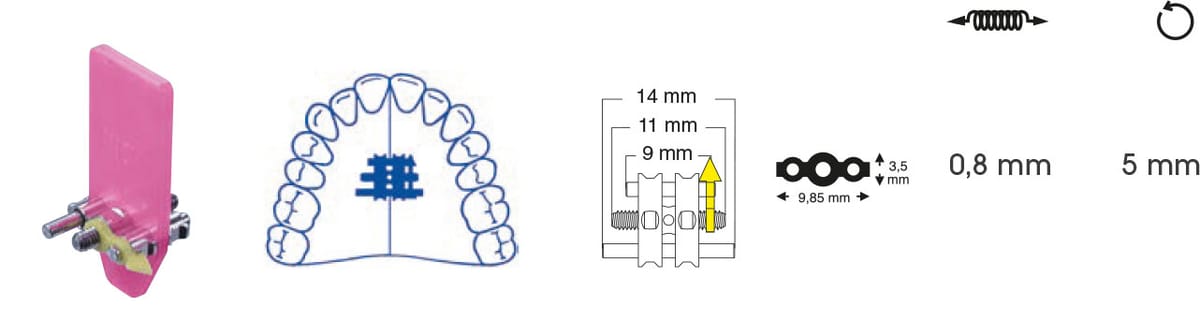 Vis d'expansion trapézoïdale – Orthobasics GmbH & Co. KG, Intraoral Appliances