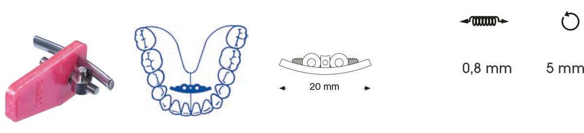 Vis d'expansion mandibulaire – Orthobasics GmbH & Co. KG, Intraoral Appliances