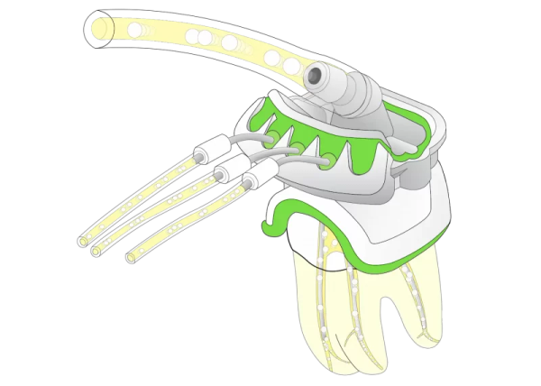 Kit PulpSucker Molaire