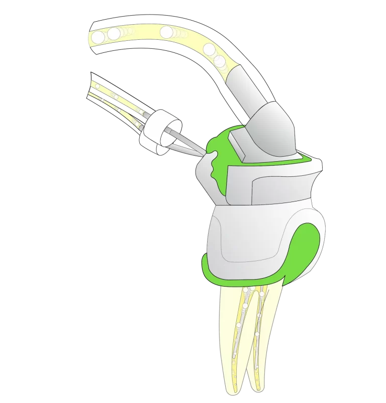 Kit PulpSucker Prémolaire – PlanB Dental, Syringes