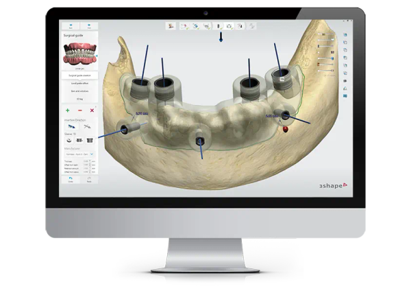 3Shape Implant Studio