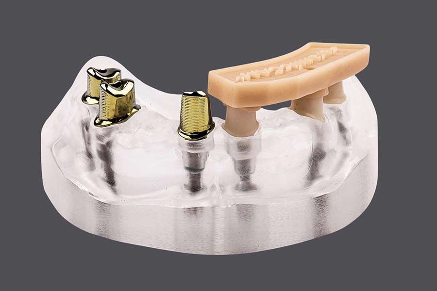 Individuelle Abutments – seramicCAM Europa GmbH, Implant Components & Abutments