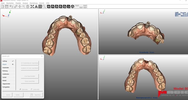 Magic® Model 3D Implant, Implant Module for Dental 1490 1461