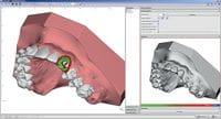 OnyxCeph³™ module Bracket Erase 3D 410-000-12