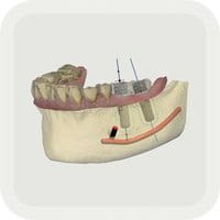 TRIOS implant planner app 420-200-01