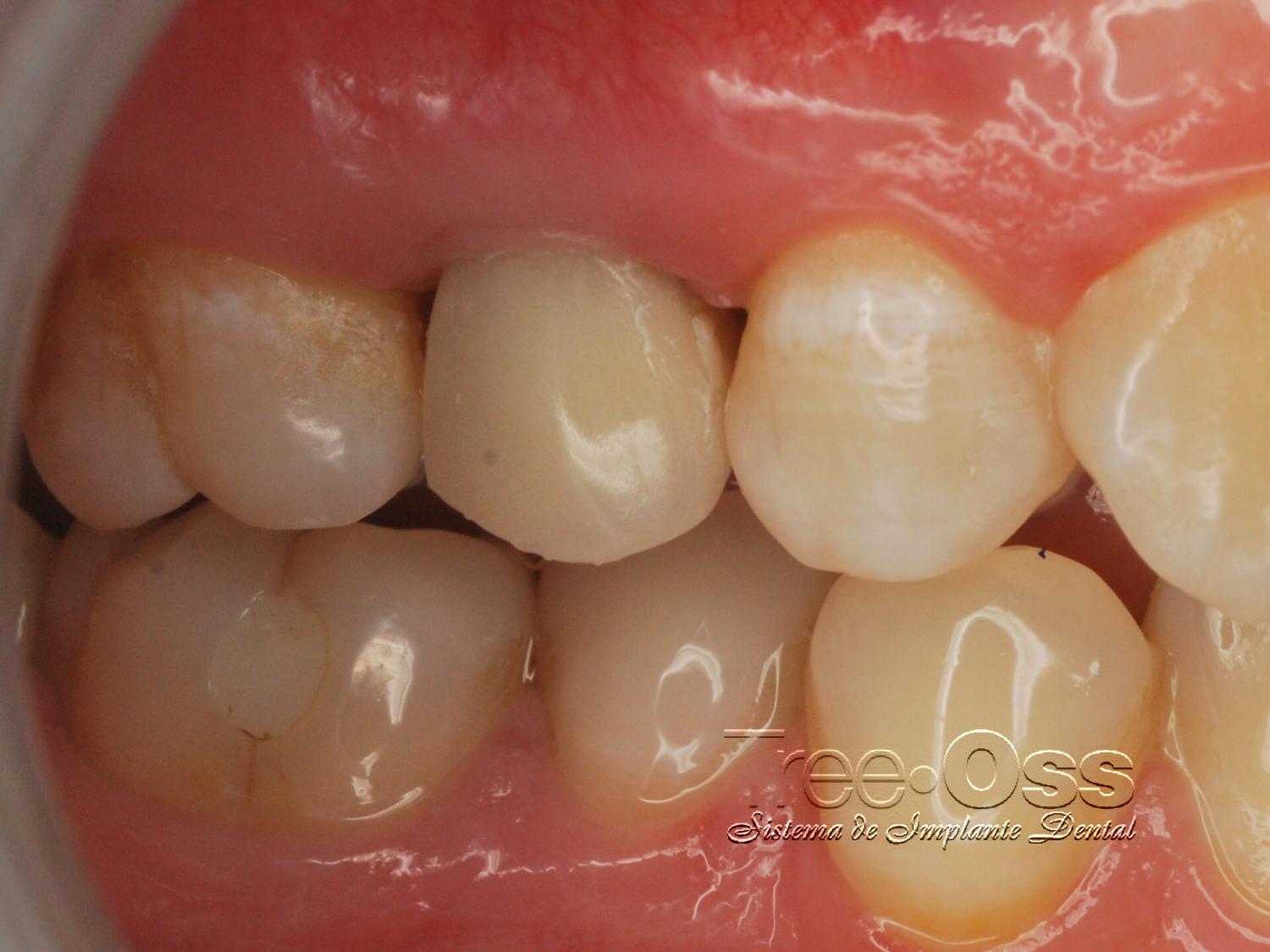 Tree•Oss HS – Tree-Oss S.R.L., Implant Systems