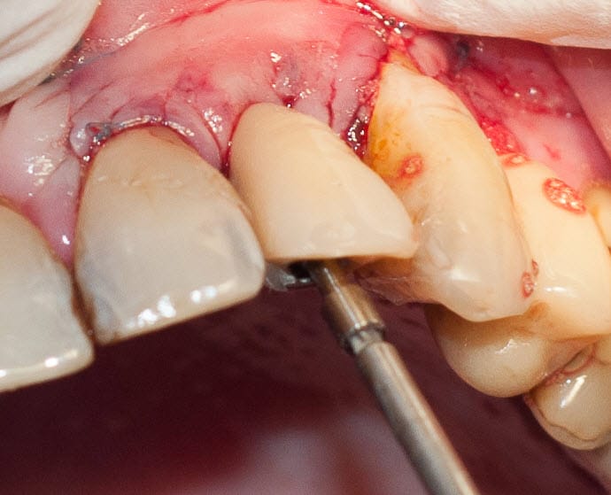 Tree·Oss SIMPLE – Tapered Implant with simplified technique internal hex connection – Tree-Oss S.R.L., Implants