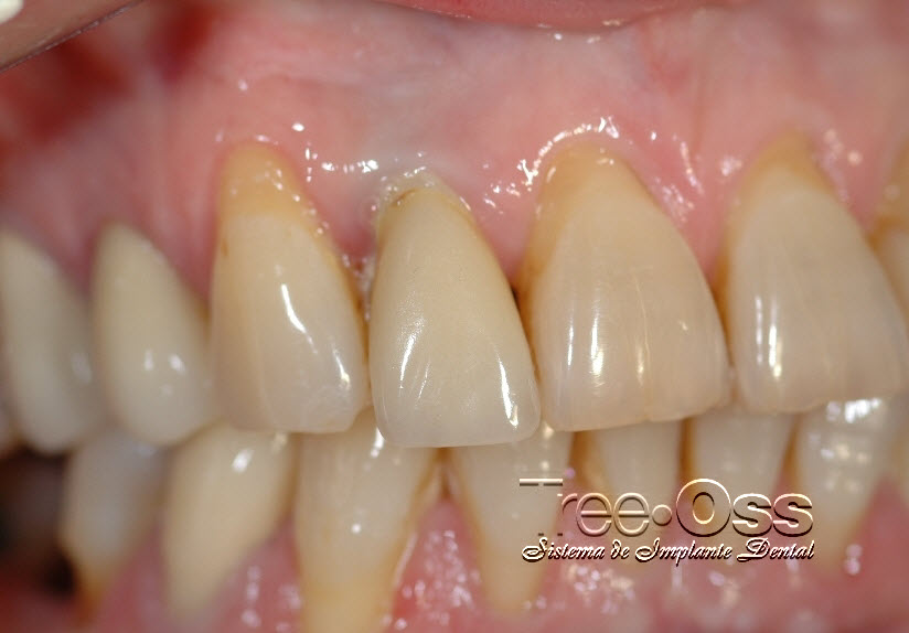 Tree•Oss ANATOMIC – External Connection – Tree-Oss S.R.L., Implant Systems
