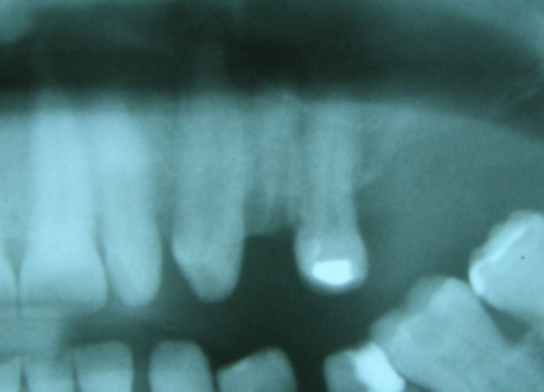 Tree•Oss ANATOMIC – Internal Connection – Tree-Oss S.R.L., Implant Systems