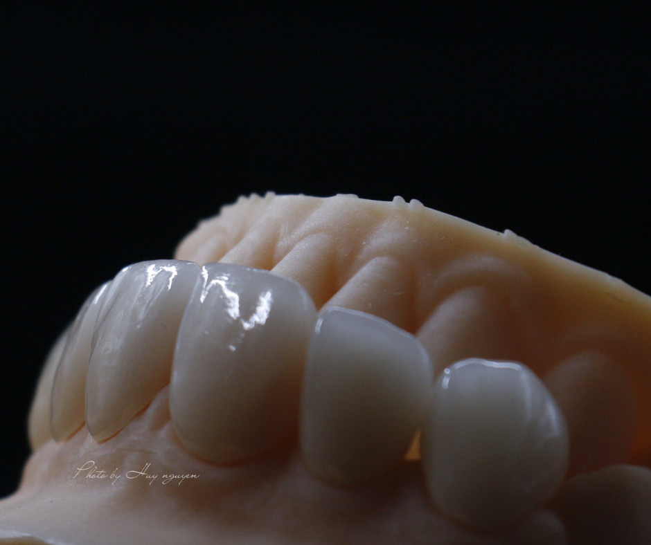 IPS E.max Dentalporzellan – Vu Gia dental lab Co., ltd, Keramikmassen