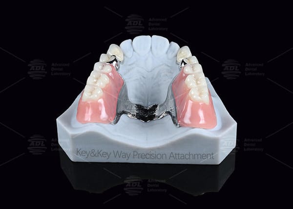 Silver Key And Keyway Attachment Easy Maintenance Precision Attachment Dental