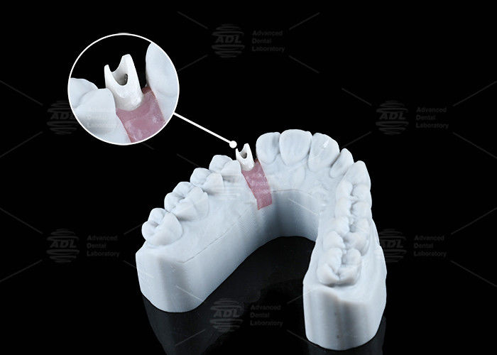 White Custom Zirconia Abutment Natural Looking Aesthetics And Optimal Functionality