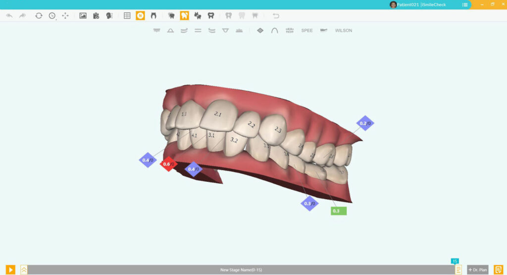 Smile Plus – Aestetika srl, Clear Aligners