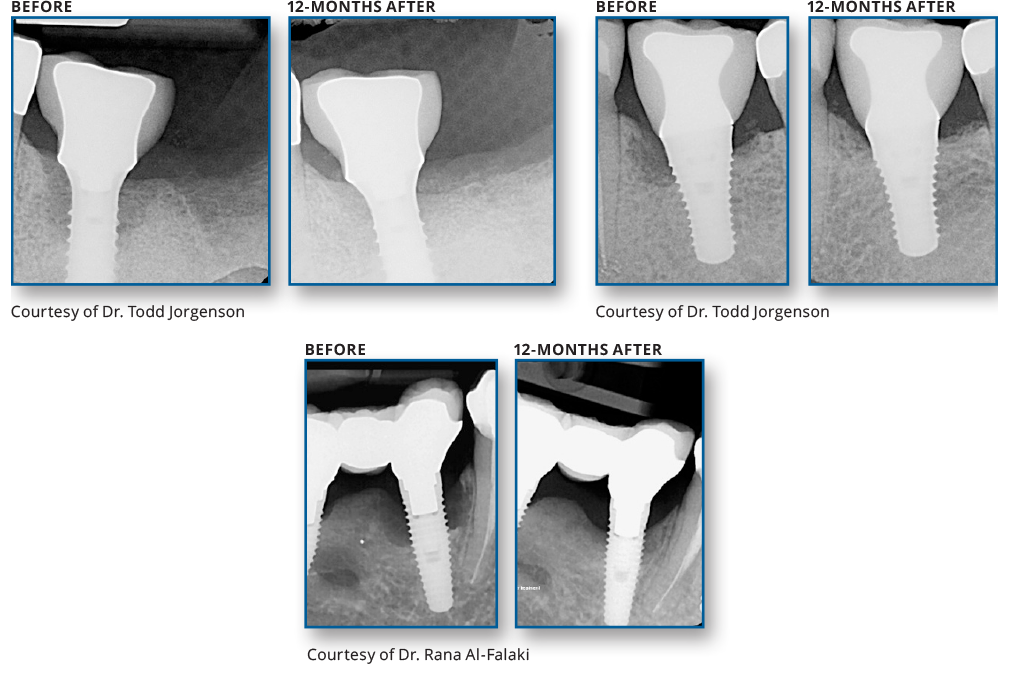 REPAIR IMPLANT™
