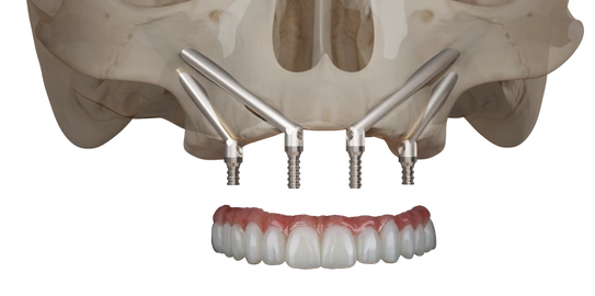 Impianti Zygoma+