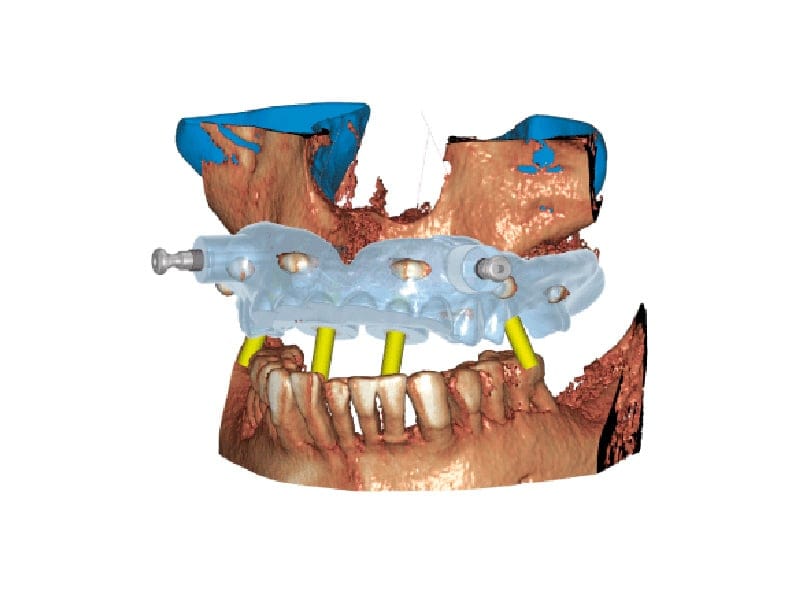 exoplan - Modulo Guide Creator – Castellini, CAD/CAM Software