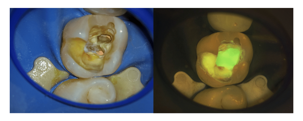 FlexionCam – CJ-Optik GmbH & Co. KG, Intraorale Kameras