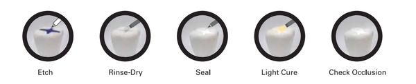 Pit & Fissure Sealant 2 SYRINGES