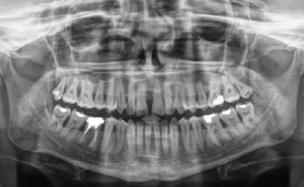 DEXIS® Titanium Röntgensensor – F1 Dentalsysteme GmbH, Intraoral X-ray Sensors & Film