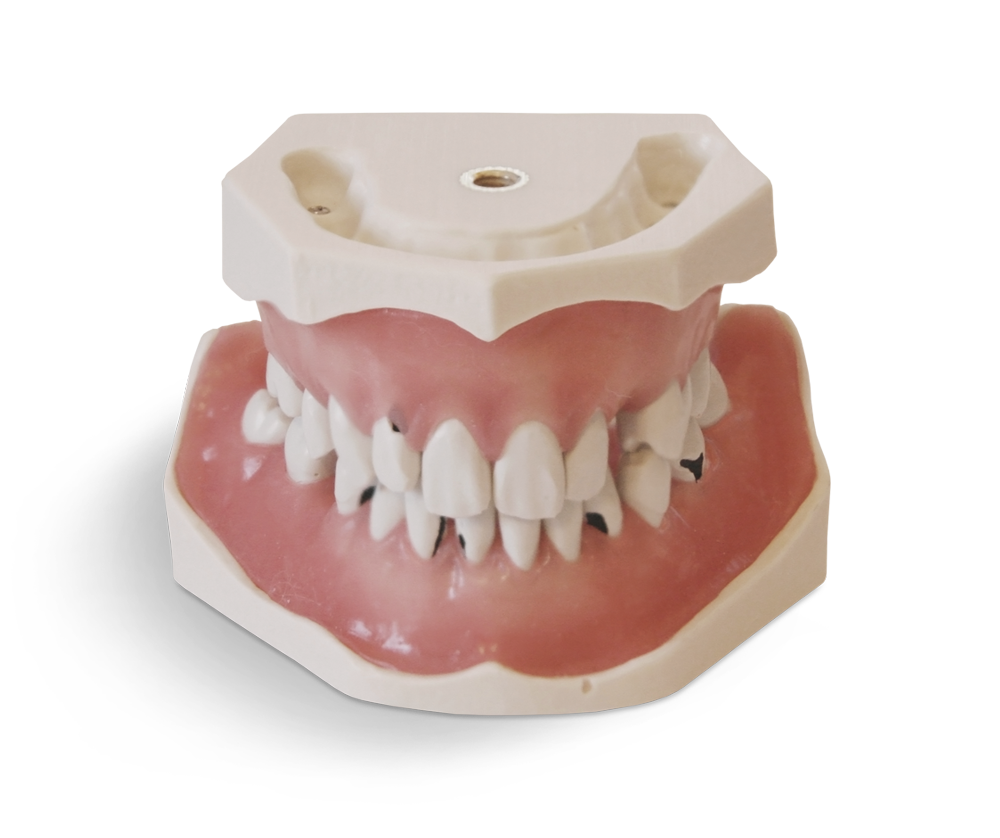 E06 – Parodontologisches Modell mit schraubbefestigten Zähnen – GF Dental di Ficuciello Antonino, Gipszusätze, Stumpflacke und Gipslöser