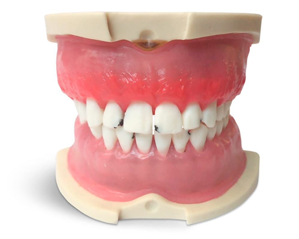 Modell mit parodontisch erkranktem Zahnfleisch – GF Dental di Ficuciello Antonino, Gipszusätze, Stumpflacke und Gipslöser