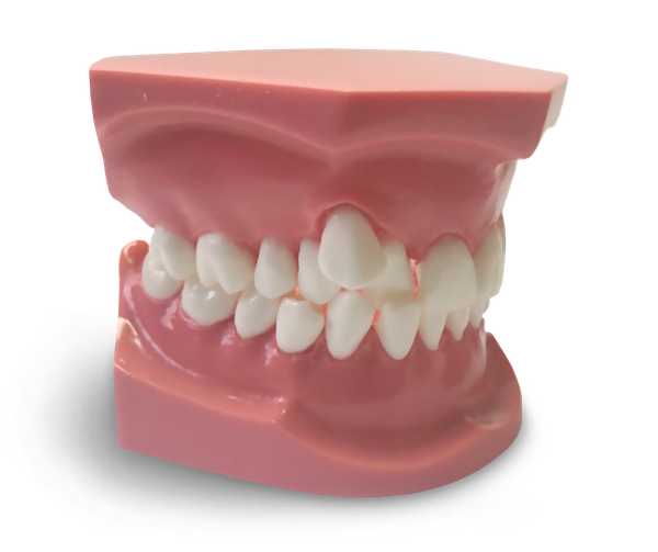 ORB05 - Modèle orthodontique avec éruption canine ectopique