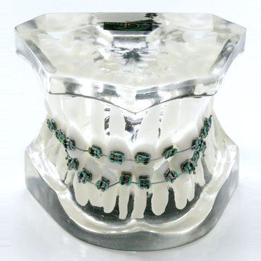 1 class model with front crowding – GF Dental di Ficuciello Antonino, Die & Model Materials