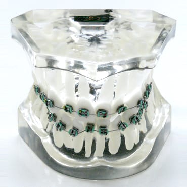 1 class model with front crowding – GF Dental di Ficuciello Antonino, Gypsum Additives, Die Hardeners and Plaster Removers