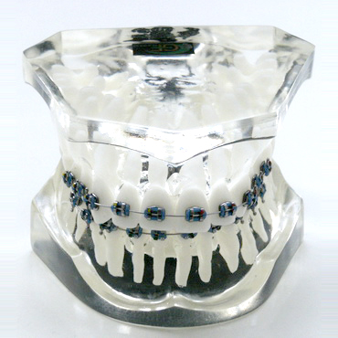 Orthodontic model 1 class 2 division – GF Dental di Ficuciello Antonino, Die & Model Materials