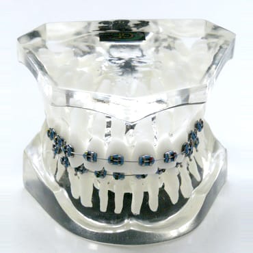 Orthodontic model 1 class 2 division