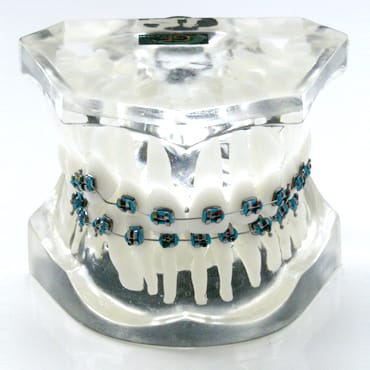 Orthodontic model with ectopic eruption of the canine