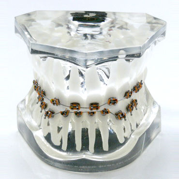 Transparent orthodontic model 2 class 2 division – GF Dental di Ficuciello Antonino, Die & Model Materials