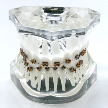 Transparent orthodontic model 2 class 2 division – GF Dental di Ficuciello Antonino, Gypsum Additives, Die Hardeners and Plaster Removers