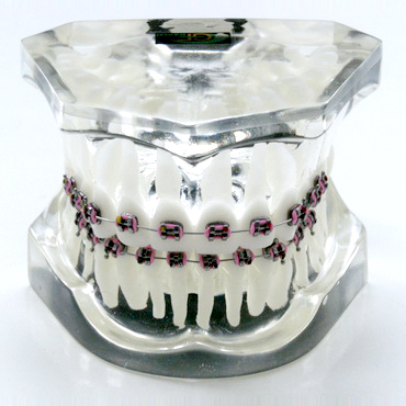 1 class orthodontic transparent model – GF Dental di Ficuciello Antonino
