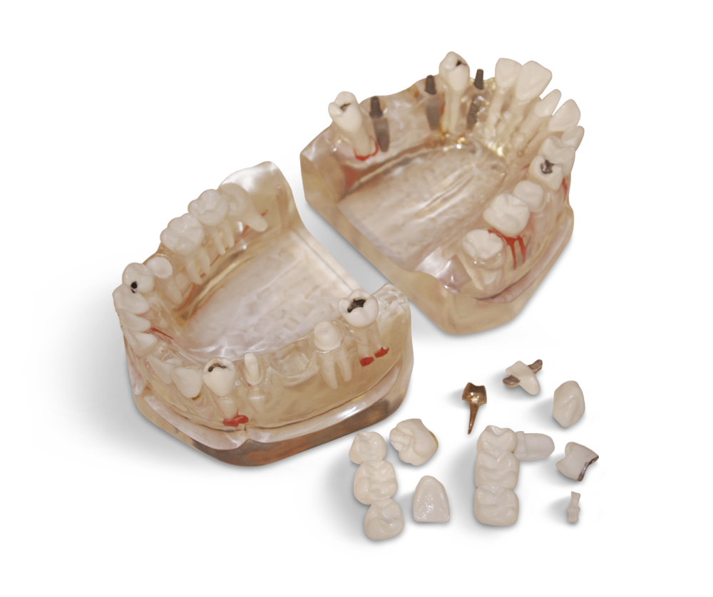 Significantly enlarged model in 3:1 scale – GF Dental di Ficuciello Antonino, Die & Model Materials