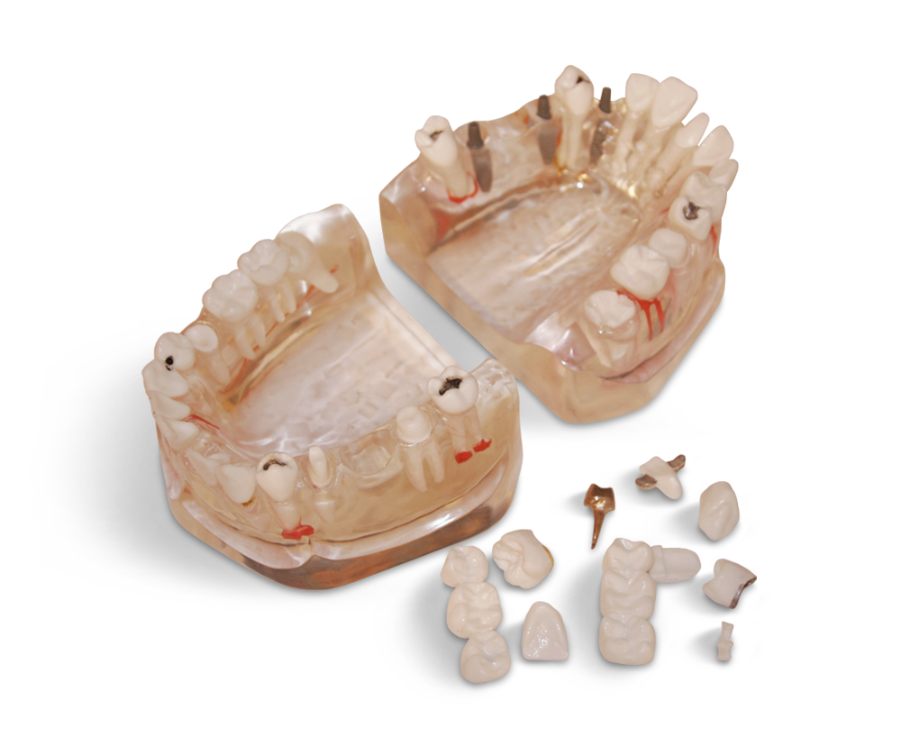 Significantly enlarged model in 3:1 scale – GF Dental di Ficuciello Antonino, Gypsum Additives, Die Hardeners and Plaster Removers