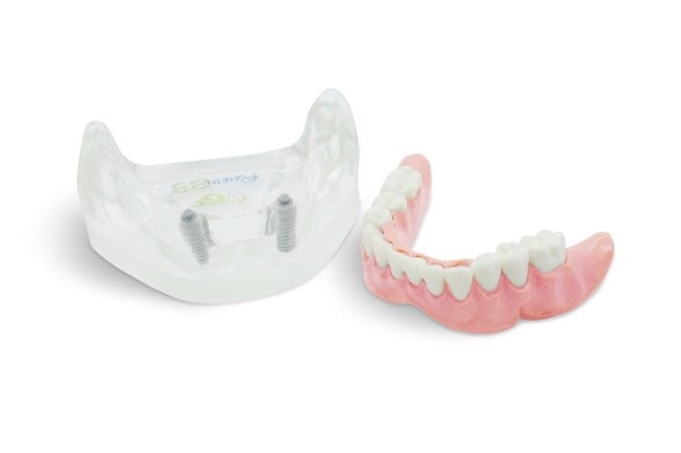 Lower overdenture model – GF Dental di Ficuciello Antonino, Gypsum Additives, Die Hardeners and Plaster Removers