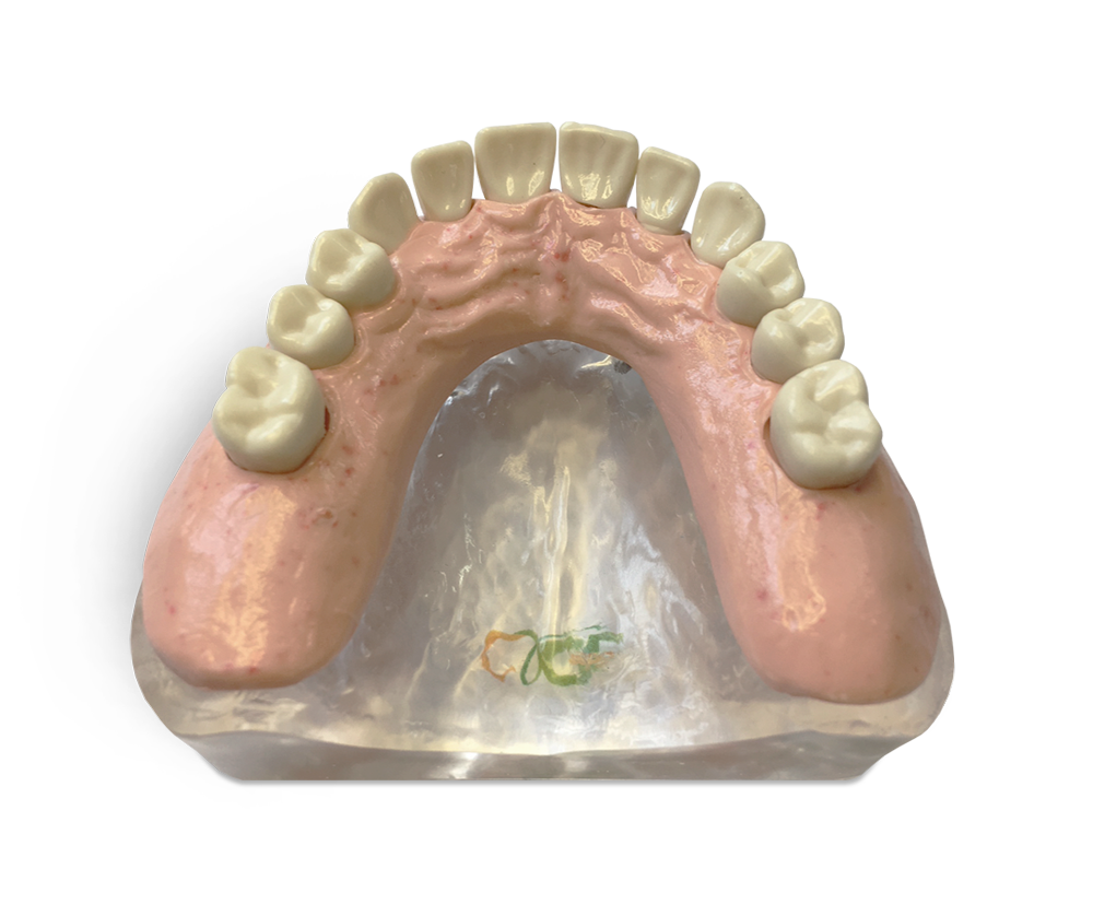 Upper overdenture model – GF Dental di Ficuciello Antonino, Gipszusätze, Stumpflacke und Gipslöser