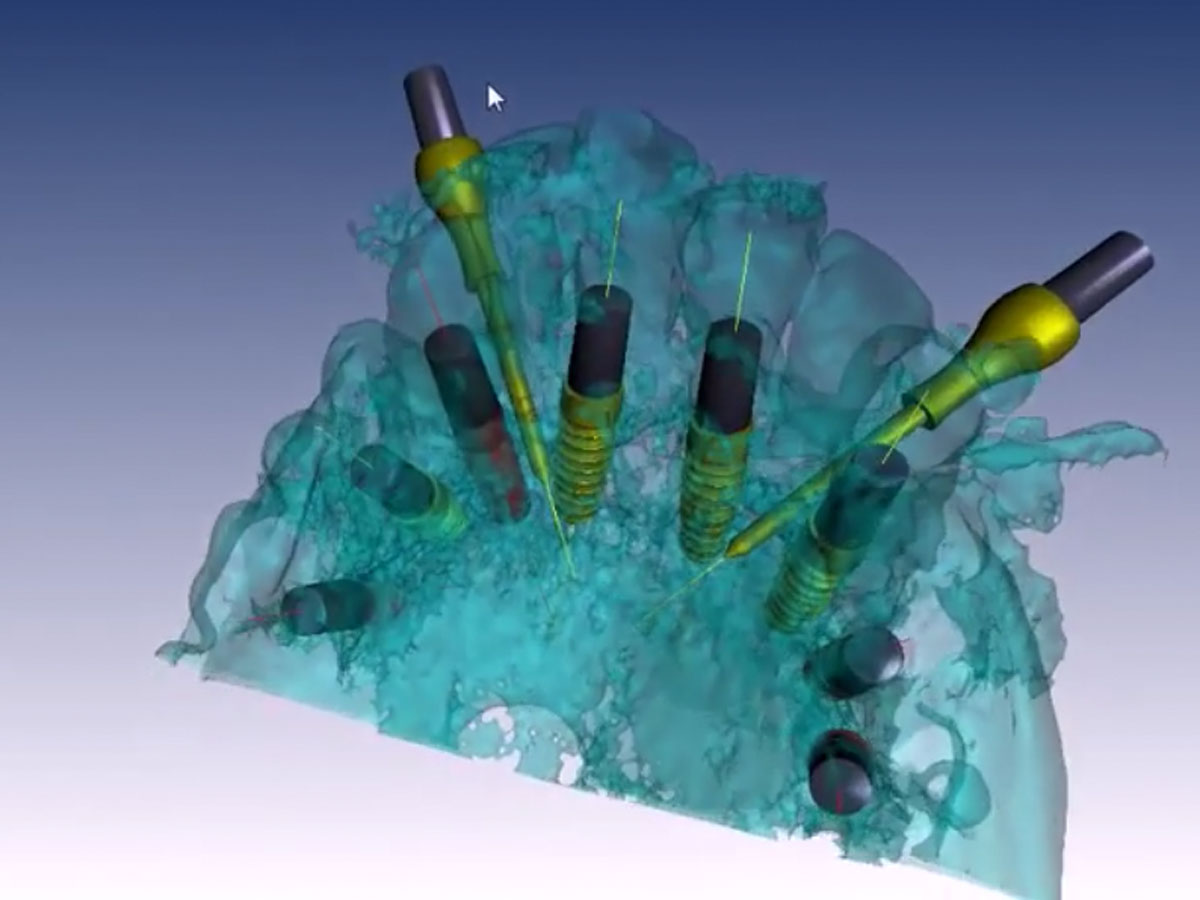 BNX 3D Guide – Ghimas S.p.A., Implant Surgical Kits