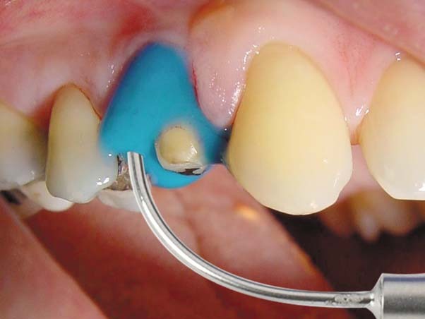 Algiloid®