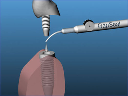 GapSeal® – Hager & Werken, Implant Components & Abutments
