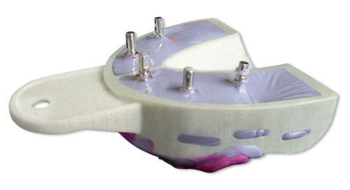 Miratray® Implant – Hager & Werken, Impression Trays & Accessories