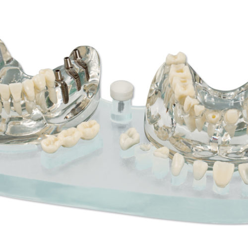 Studienmodell Demo Implant C+B – Hager & Werken, Die & Model Materials