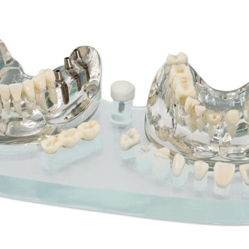 Pièces de rechange restauration modèle démo implant