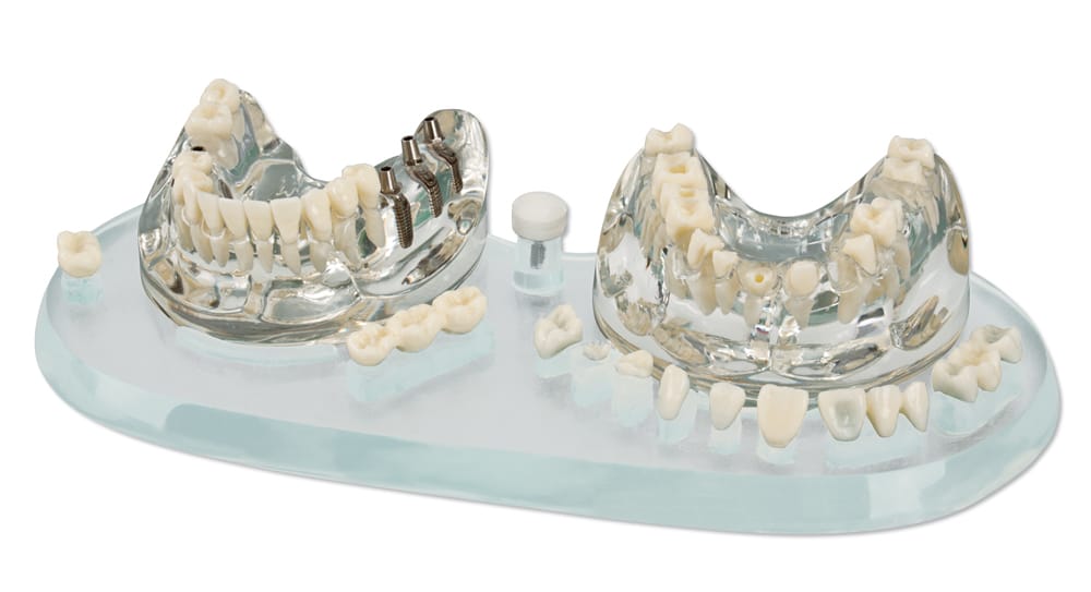 Studienmodell Demo Implant C+B – Hager & Werken, Demonstration Models