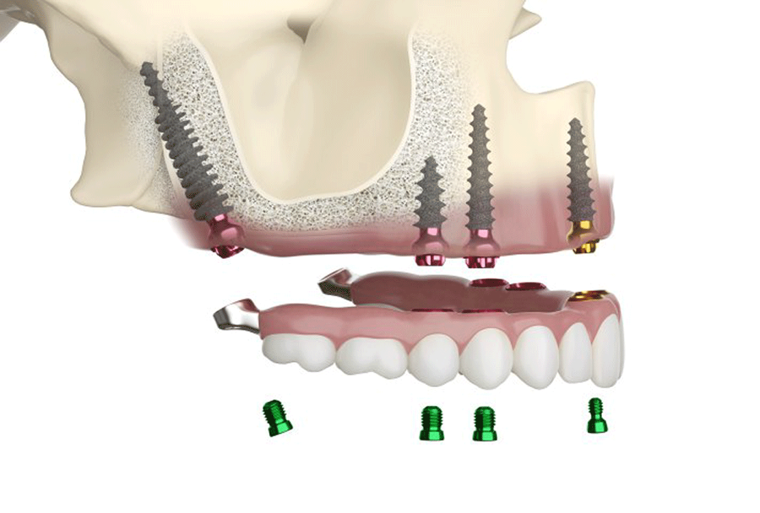 ROOTT M Implant – Hayat Dental, Implantology