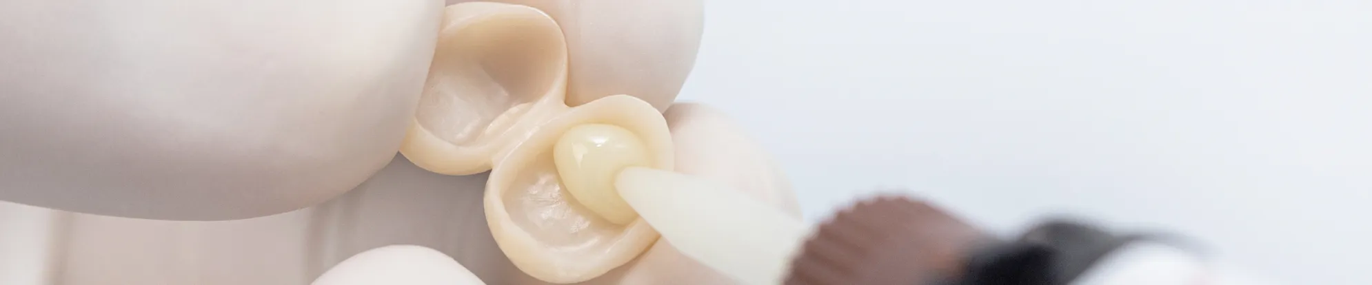 Dental Adhesive Resin Cement Solution – Shandong Huge Dental Material Corporation, Dental Cements