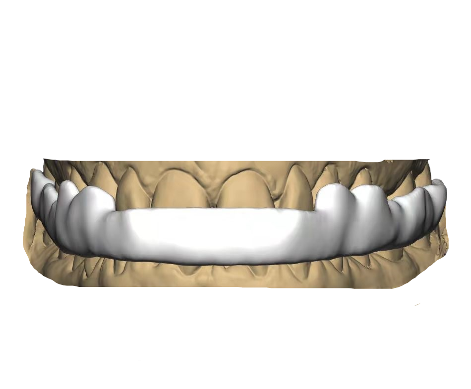 Nightguard/Splint Design Service – League Dental Laboratory, Prothesenkunststoffe