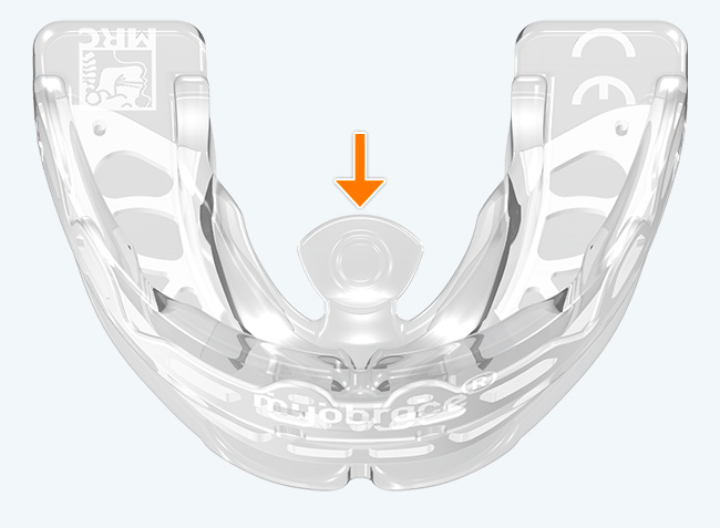 Myobrace® Adult Aligner AA3 - Stage 3