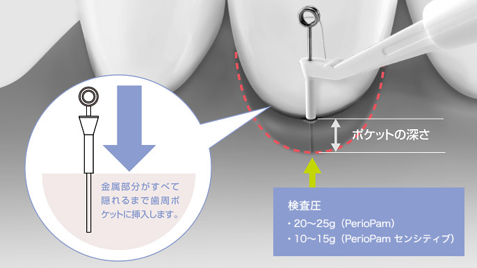 PerioPam（ペリオパム） – Narcohm Co., Ltd., Periodontal Diagnostics